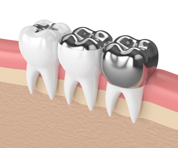 Medical, Dental Amalgam